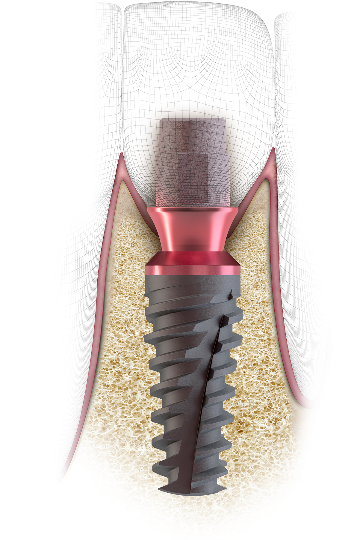 GENESIS ACTIVE Implant System from Keystone Dental | Image Credit: © Keystone Dental Holdings