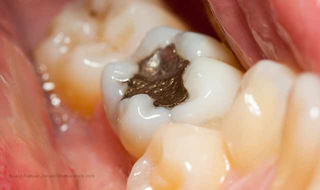 Having multiple fillings could cause toxic levels of mercury in blood