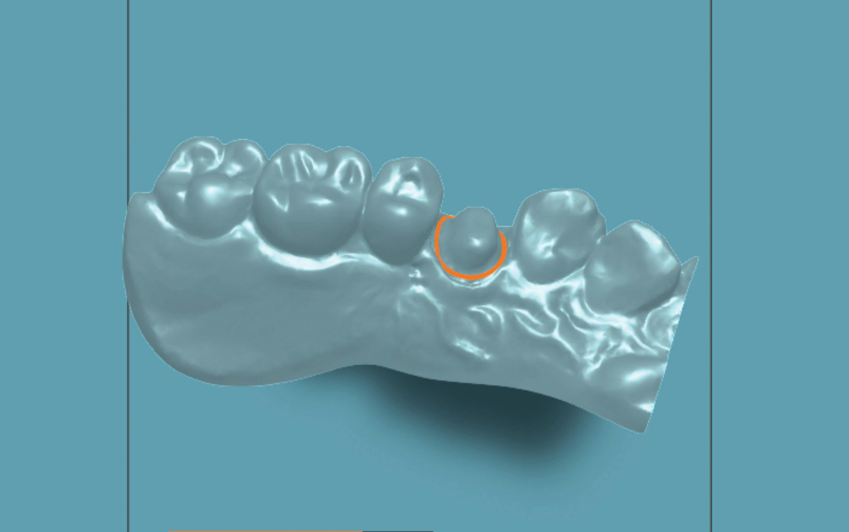 Pearl’s Smart Margin AI technology has been trained by dental professionals to score scans and perform margin marketing with accuracy, adding efficiency and cost-saving to dental laboratories and their practice clients.