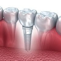 Nearly 8% of Patients Lose At Least One Implant Within a Decade