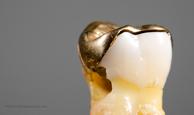 New dental fillings could actually REPAIR tooth decay