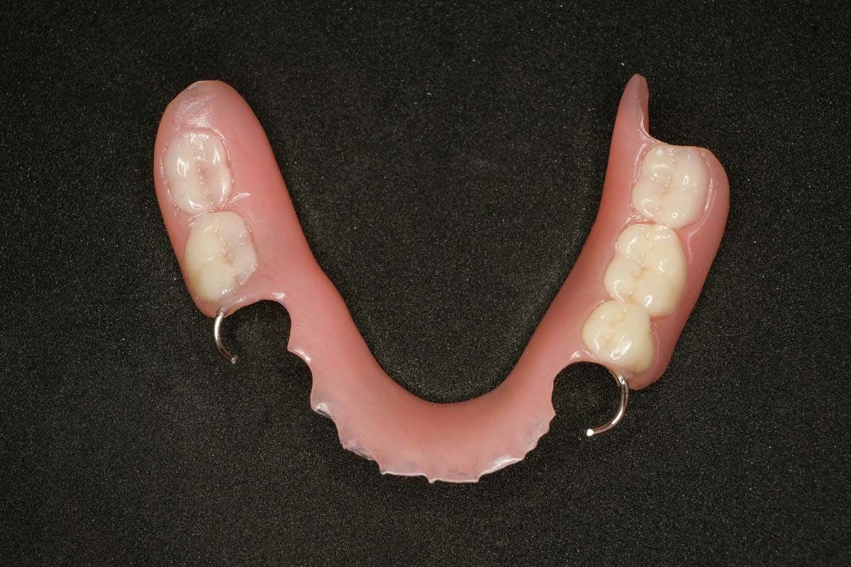 Flexible Partial Dentures: The Pros and Cons to Consider. Image credit: © trailak - stock.adobe.com