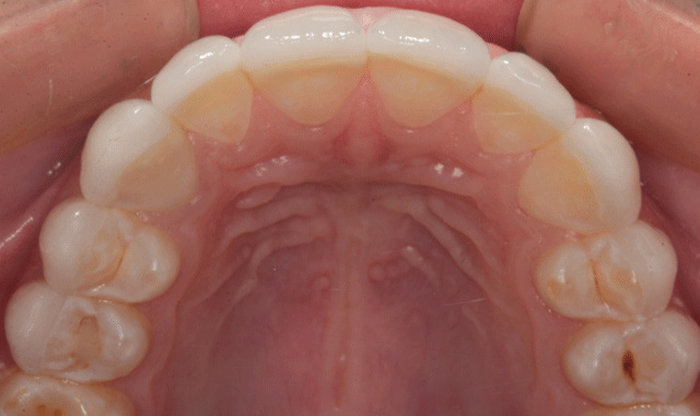 Incisal view of final result