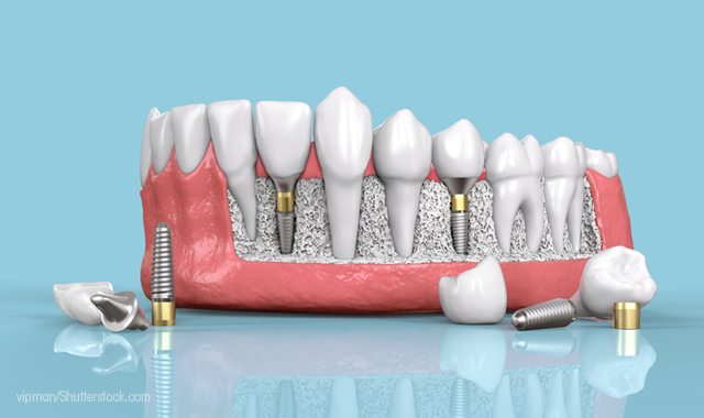 8 dental implant tips you need to know