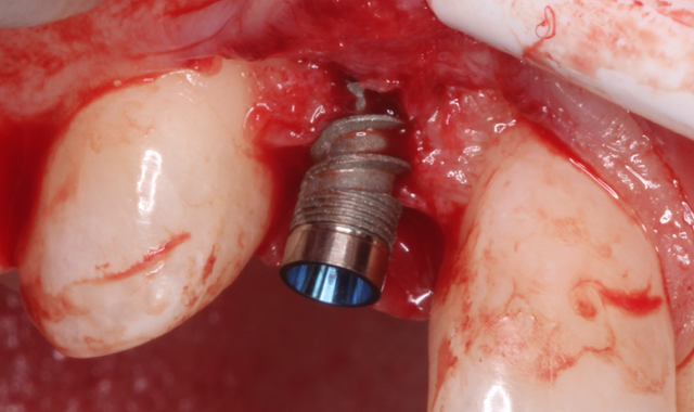 The 3.0 mm x 16 mm Hahn Tapered Implant was initially inserted with a handpiece and threaded into final position with a torque wrench.