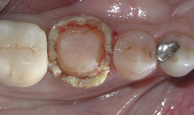 Fig. 10 Occlusal view of tooth #30 after Traxodent (Premier Dental) retraction paste has been placed