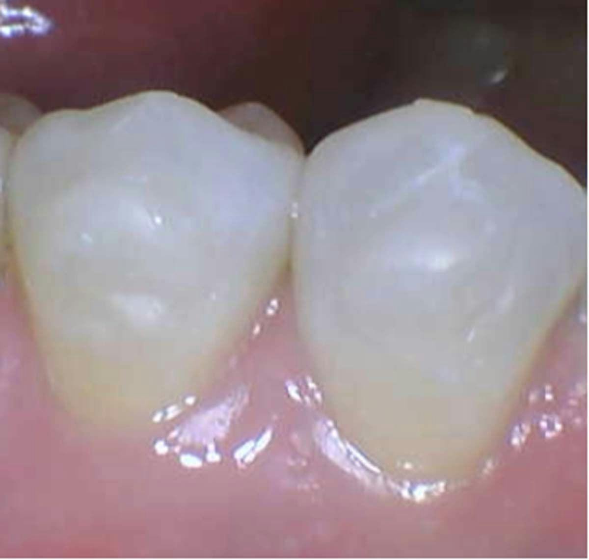 Clinical photo by Dr. Stephanie Vondrak Vondrak Dental  Elkhorn, NE