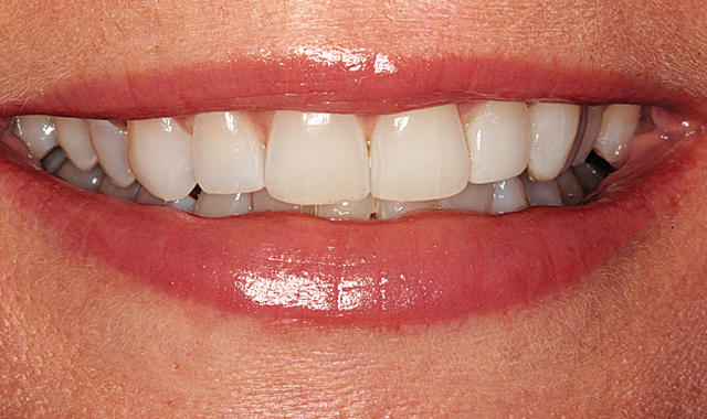 How to simplify alignment and bonding for smile enhancement