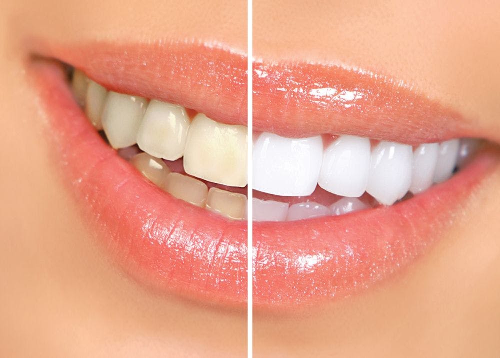 The Future of Teeth Whitening 