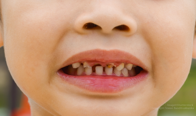 Study finds virulent bacteria linked to caries in children