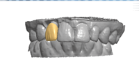 The final crown was designed in concert with the custom abutment to optimize the gingival margins and emergence profile.