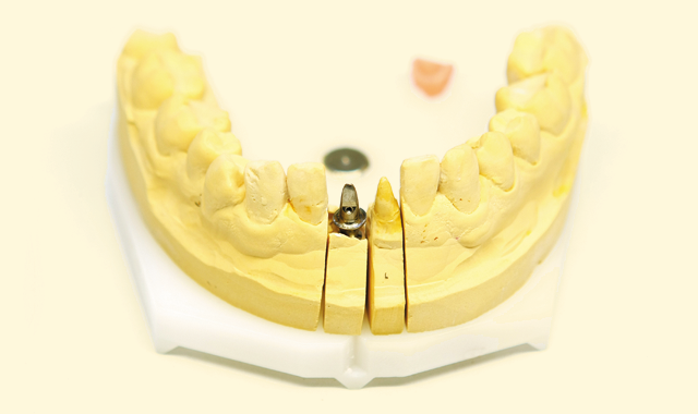 A dental model with an implant analog in place.
