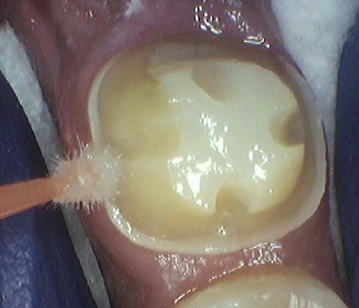 Leaving the Hemaseal & Cide slightly moist, the tooth is ready for bonding or cementation (Figure 3). 
