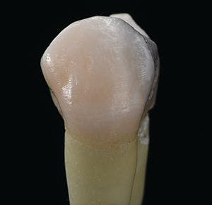 Fig. 1 - Premolar tooth restored with a proximal amalgam restoration.