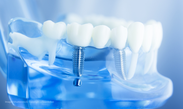 5 ways technology has changed the implant workflow