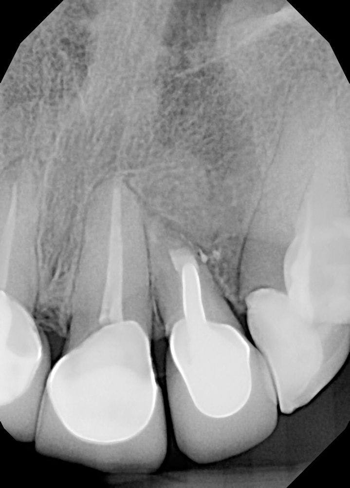 Deep Dive: Dental Lasers Enhance Root Canal Treatments for Both Patients and Providers