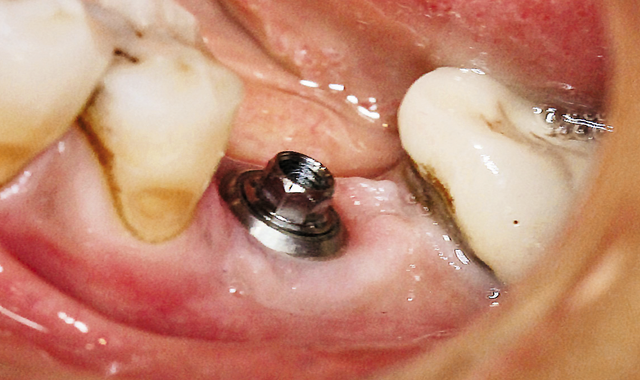 Abutment for screw-retained crown.
