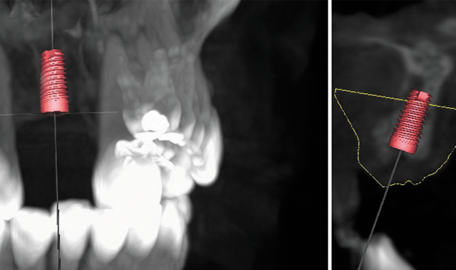 Implant alignment in the CBCT scan.