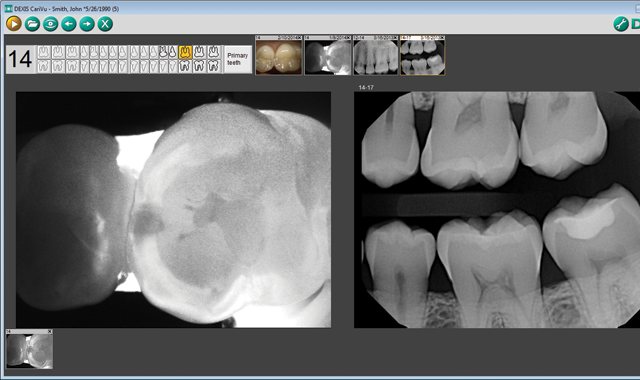 How to gain an inside view of caries using detection technology