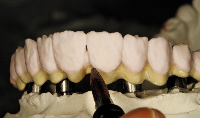 Technique: Building a full-mouth hybrid denture