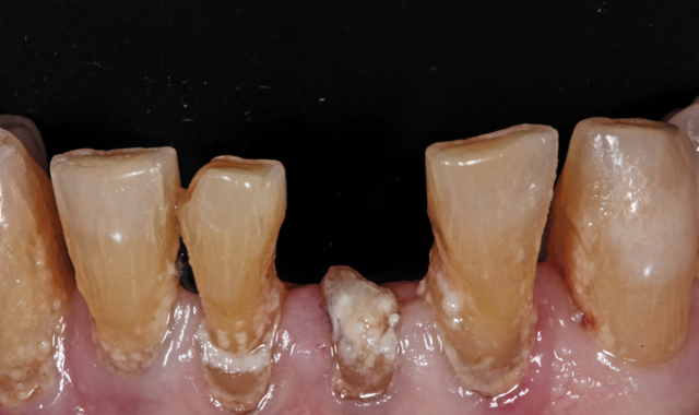 damage to the remaining anterior mandibular teeth