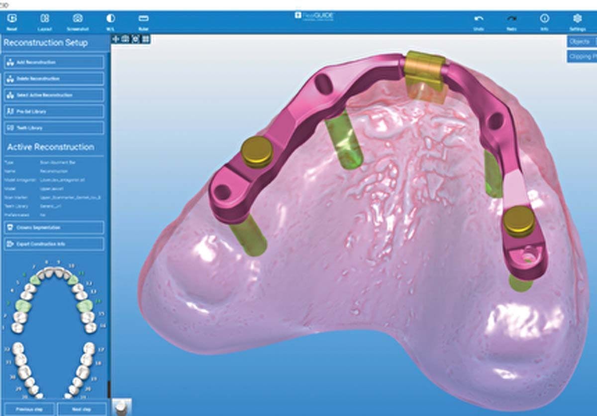 RealGuide from ZimVie is a software module that enables clinicians to design the optimal restorative system for their patients, bolstering the digital implant workflow in the dental practice.