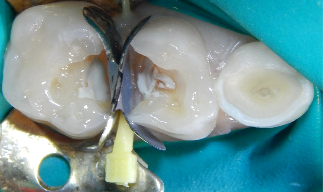 How to use cavity liners to provide better care