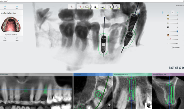 How guided implant surgery can deliver better patient care