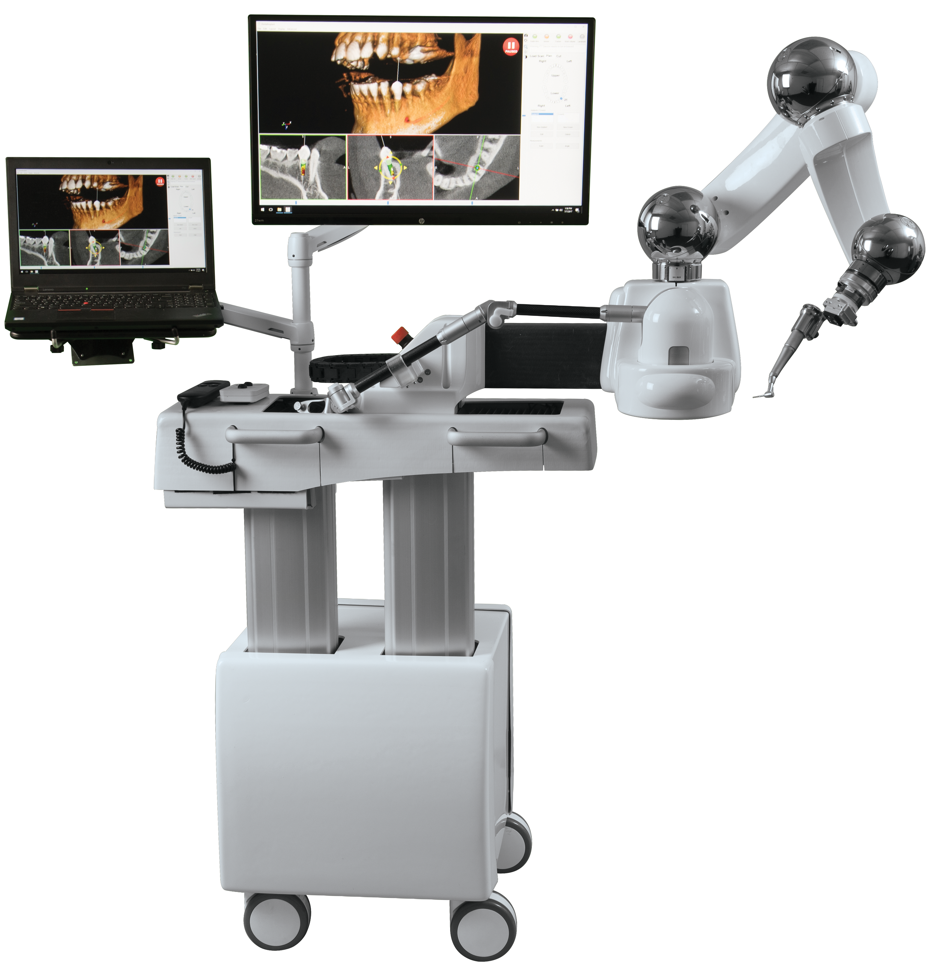 How to Achieve Accurate Implant Placement Using Robotic Guidance