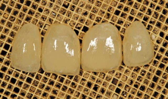 Step-by-step: Low-cost veneers for a cost-conscious patient