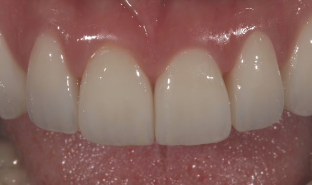 Dental zirconia and keys for clinical success