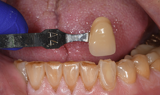 How to enhance efficiency and predictability with composite restorations