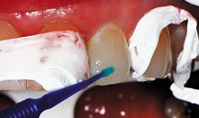 Bond Force adhesive is dispensed from the pen into a dappen dish when ready to apply to the tooth.