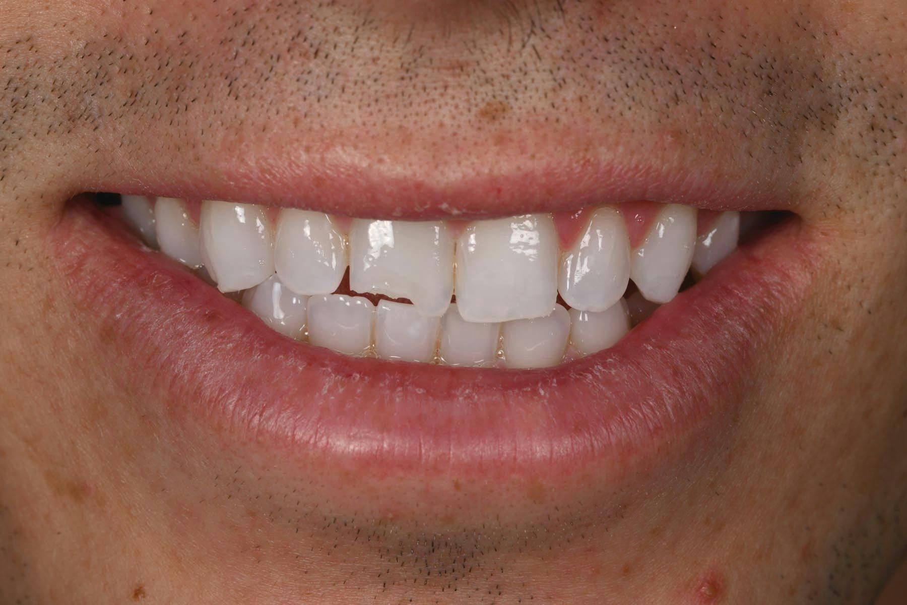 Using a Simplified 2-Layer Technique to Restore a Fractured Maxillary Central Incisor