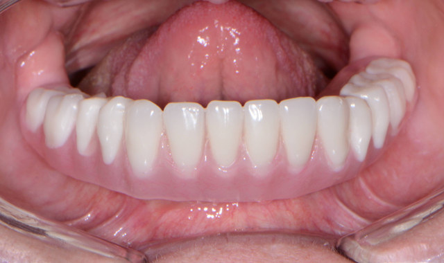 How to provide full-mouth reconstruction with dentures and overdentures
