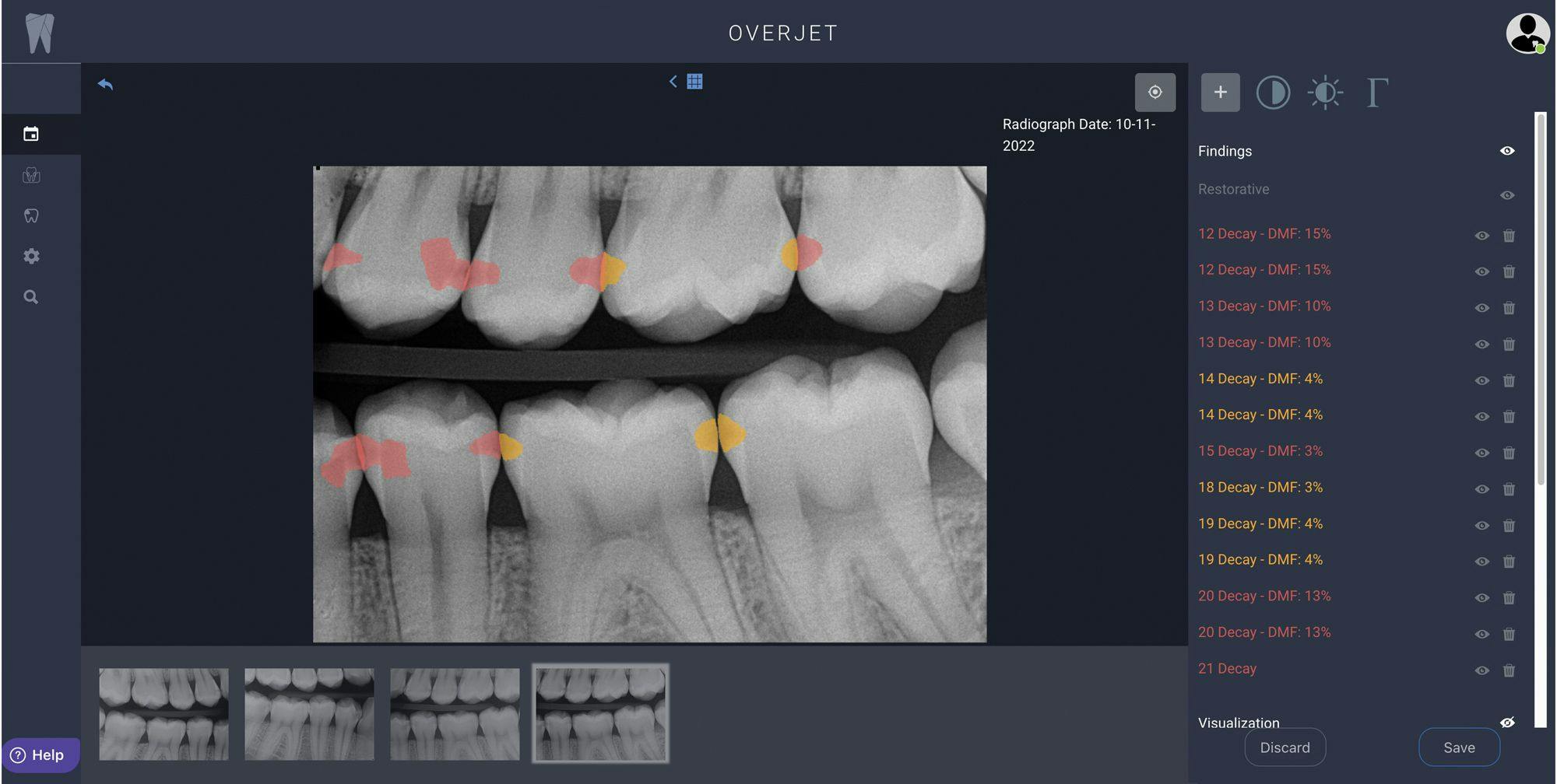Overjet’s artificial intelligence analyzes x-rays in real time, providing clinicians with a full view of possible decay or periodontal disease markers