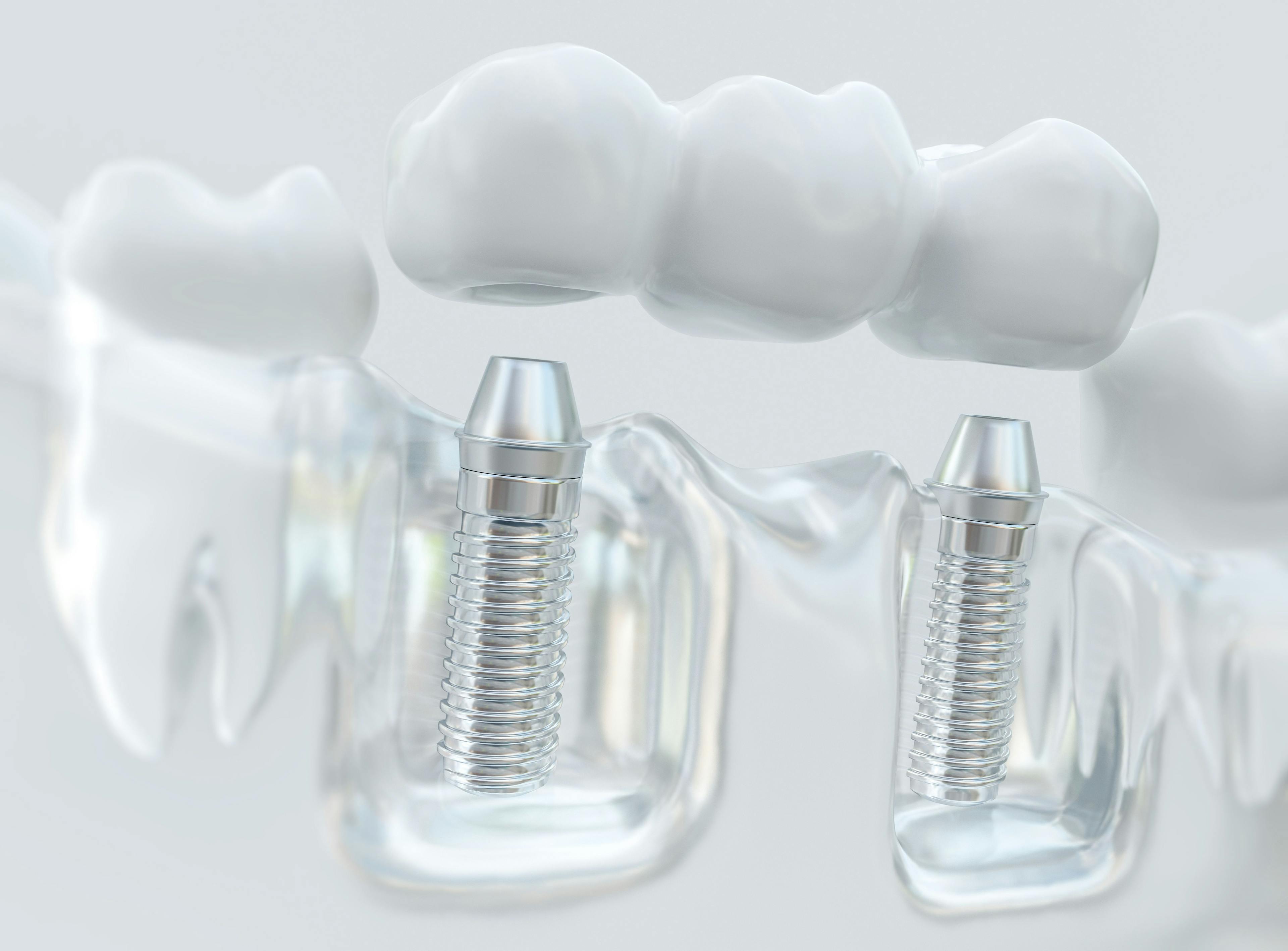 Material Considerations When Restoring Dental Implant Cases