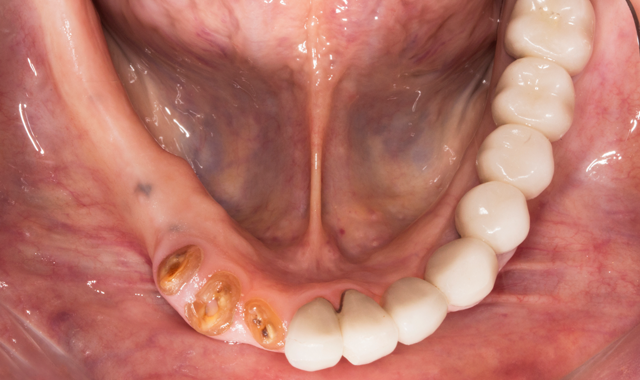 Preop Occlusal view
