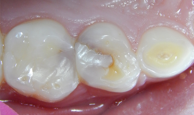 Upper right quadrant with leaking restorations