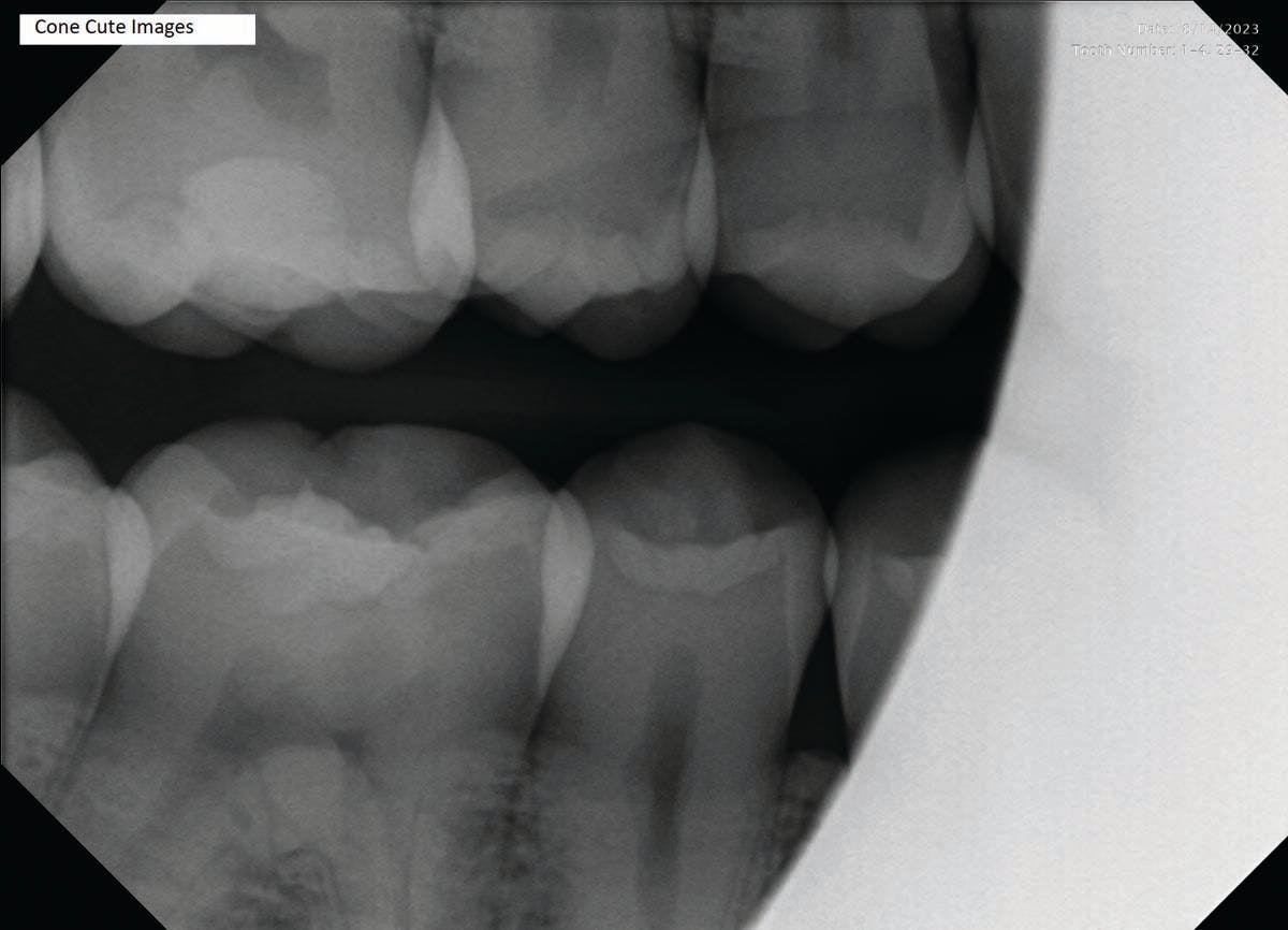 Cone Cut Images. Cone cuts are a common positioning error. To avoid this problem, align the x-ray cone with the aiming ring of the positioner to ensure you are pointing directly at the sensor. | Image Credit: © DentiMax