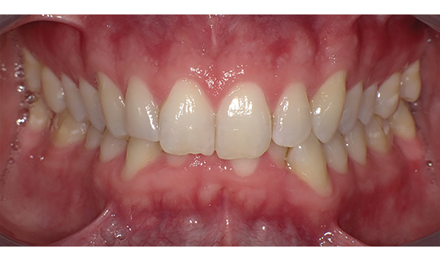 How to do more with less in clear aligner therapy