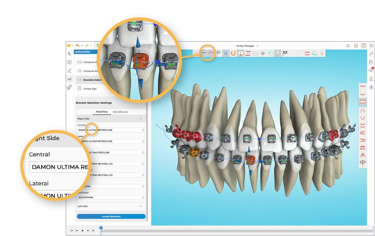 Clinicains can streamline daily workflow and achieve customized bracket positioning by leveraging Damon Ultima™ brackets and the Spark Approver Software. Credit: © Ormco Corp.