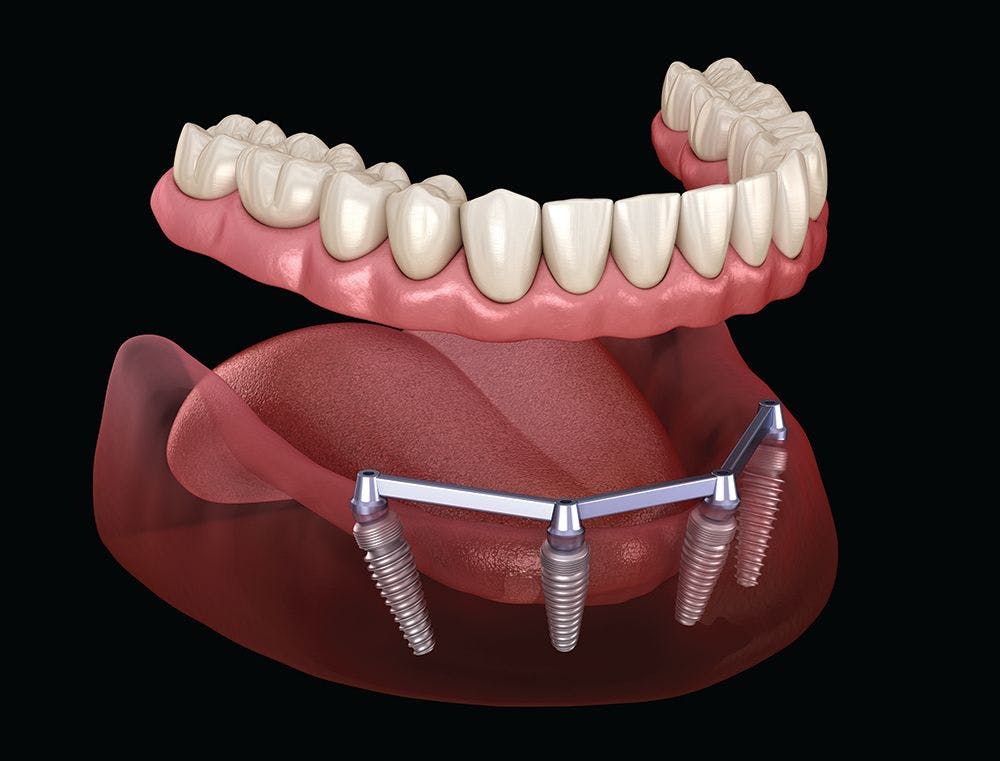 Dentures being affixed to an implant supported bar -  Alexandr Mitiuc / stock.adobe.com