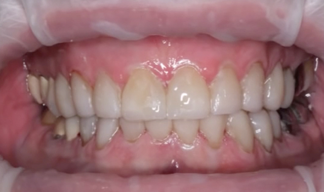 How to perform full-mouth composite restorations with ACTIVA BioACTIVE