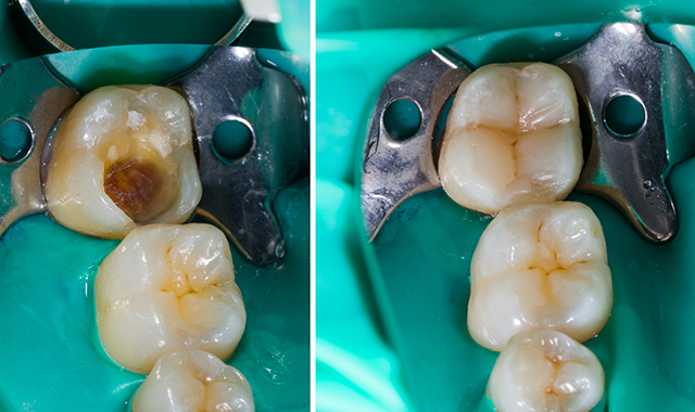 Dental Composites Continue to Transform Clinical Dentistry