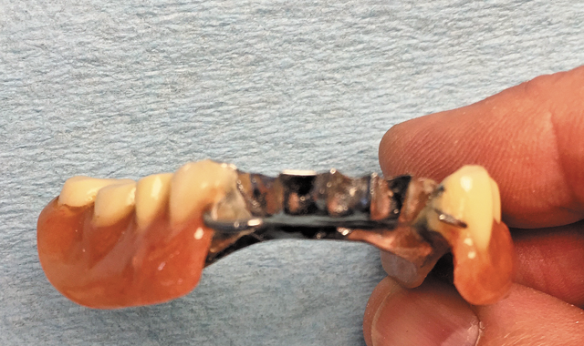 Technique: An easier way to repair partial dentures
