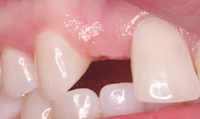 Initial condition of edentulous space.