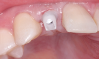 The custom abutment fit perfectly, establishing margins just below the soft tissue. Teflon tape was placed over the fixation screw. 