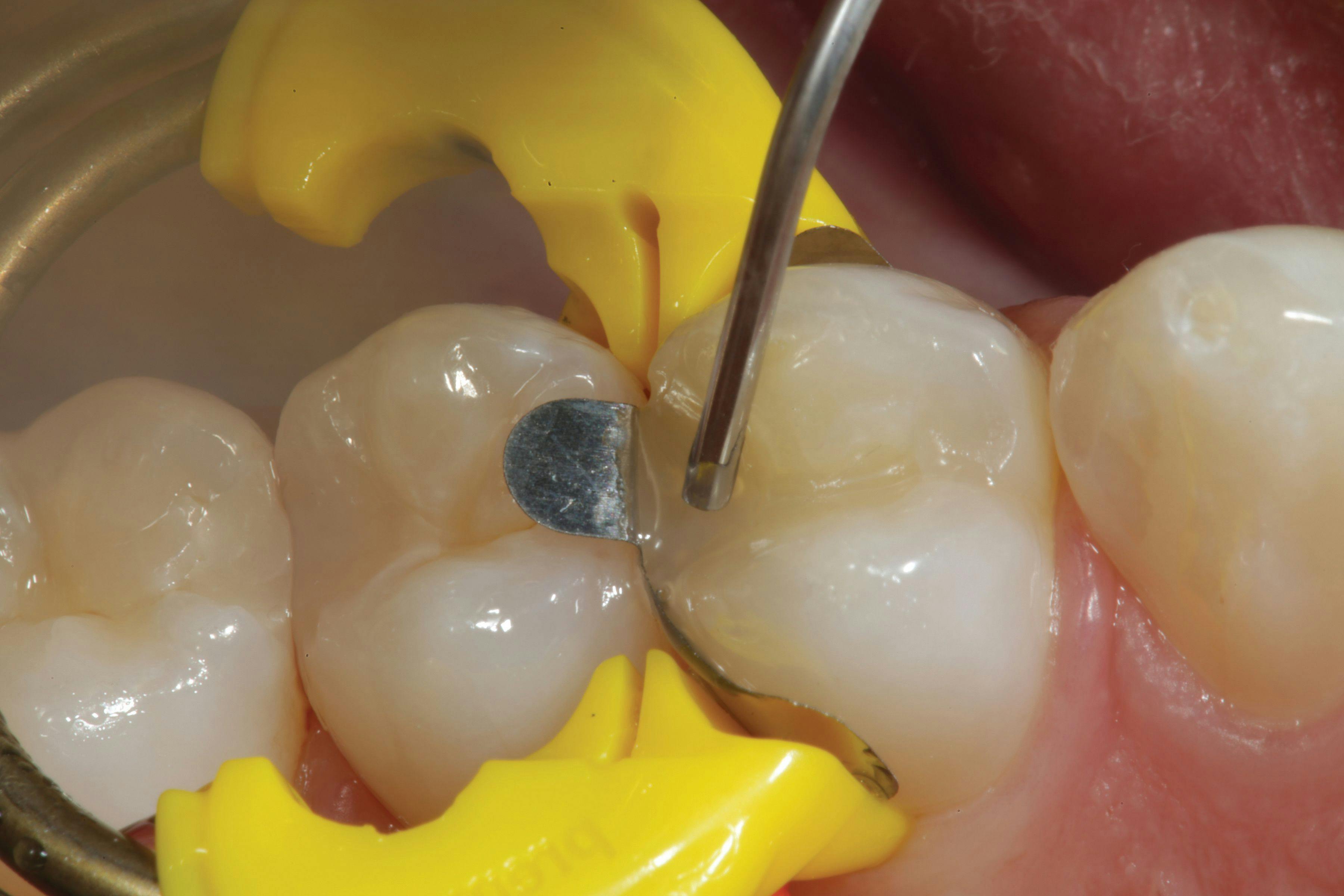 How to Bulk Fill Flowable Composite Restorations Without a Capping Layer
