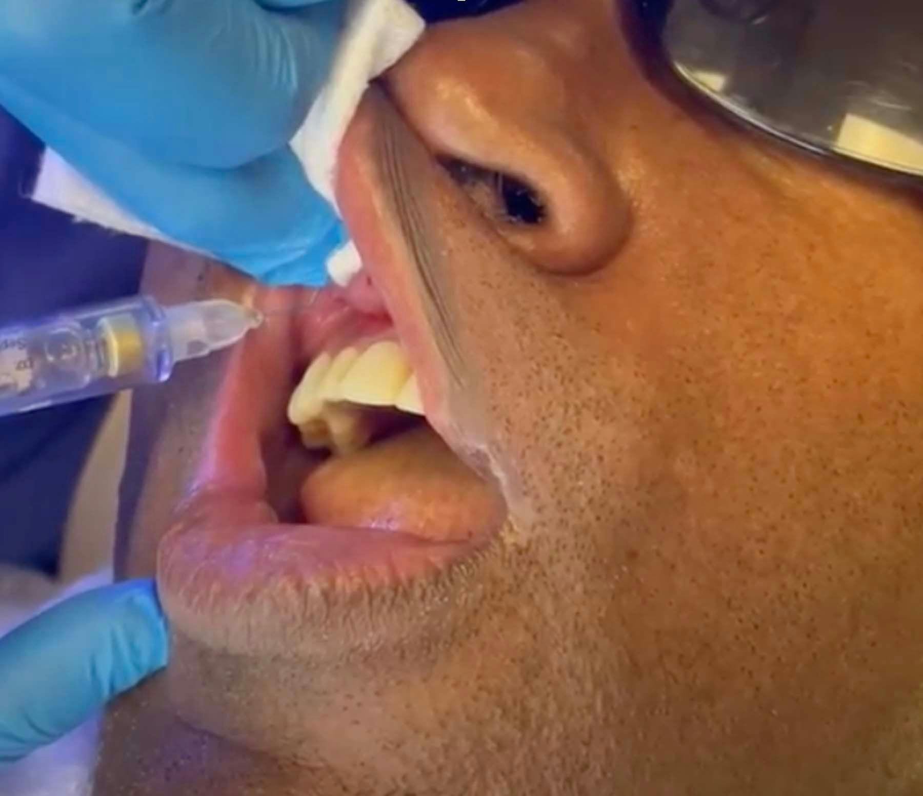 Figure 1. Labial vestibular injections just under the nostrils are often the most painful injections. With nearly 100% consistency, the Calaject computerized anesthetic technique resulted in zero pain for this otherwise stressful and uncomfortable procedure. Clinical images courtesy of Tony Tomaro, DDS